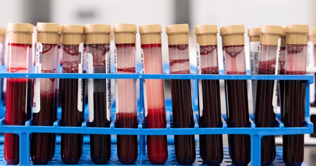 Exame de sangue Galleri detectando múltiplos tipos de câncer